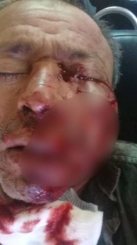 Navajeado en el rostro